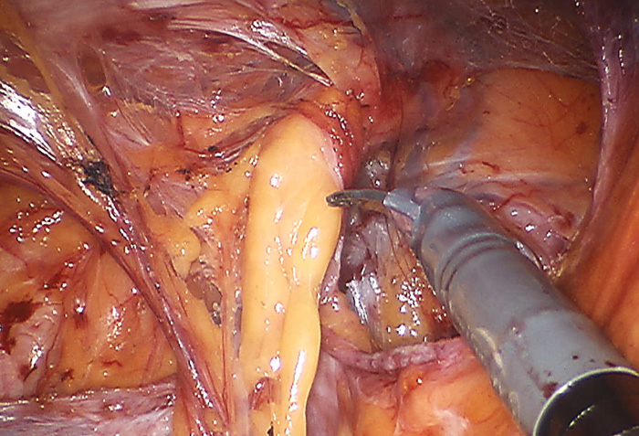 Types of Abdominal Wall hernia by Dr. Iraniha